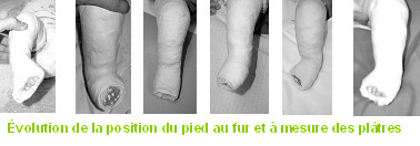 Chu De Nantes Qu Est Ce Qu Un Pied Bot Varus Equin Traitement Selon La Technique De Ponseti Chu De Nantes Qu Est Ce Qu Un Pied Bot Varus Equin Traitement Selon La Technique De Ponseti