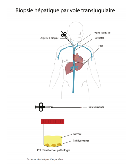 Chu De Nantes Biopsie Hépatique Par Voie Transjugulaire