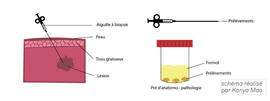 CHU de Nantes - La ponction biopsie