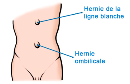 Ceinture hernie abdominale pour enfants AM-PPB