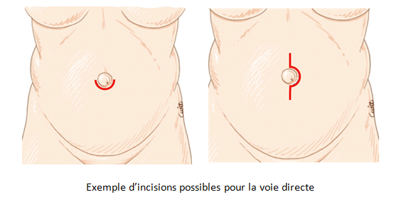 CHU de Nantes - Cure d'éventration de la hernie ombilicale et de ...