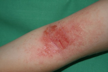 Eczema coude photo