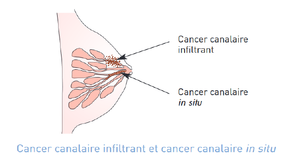 Types de cancer du sein 