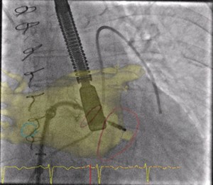 on utilise à Nantes, lors de la procédure, une nouvelle technique de fusion entre une image de scanner et l’image de scopie qui semble faciliter la manipulation du matériel dans le cœur et diminuer le temps de procédure et d’irradiation du patient.